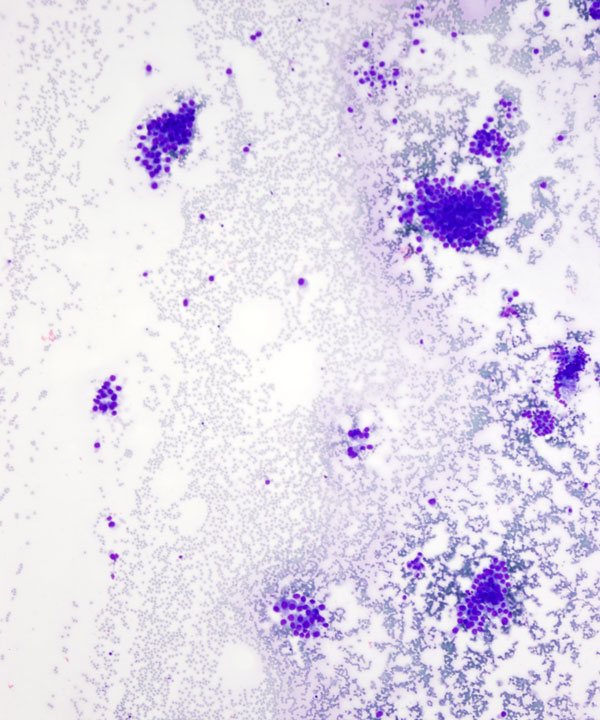 image showing 'Ductal Adenocarcinoma'