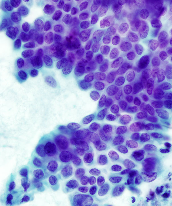 07 : Pancreas Ductal Adenocarcinoma