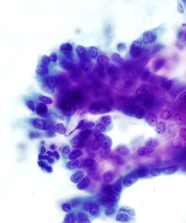 12 : Pancreas Ductal Adenocarcinoma