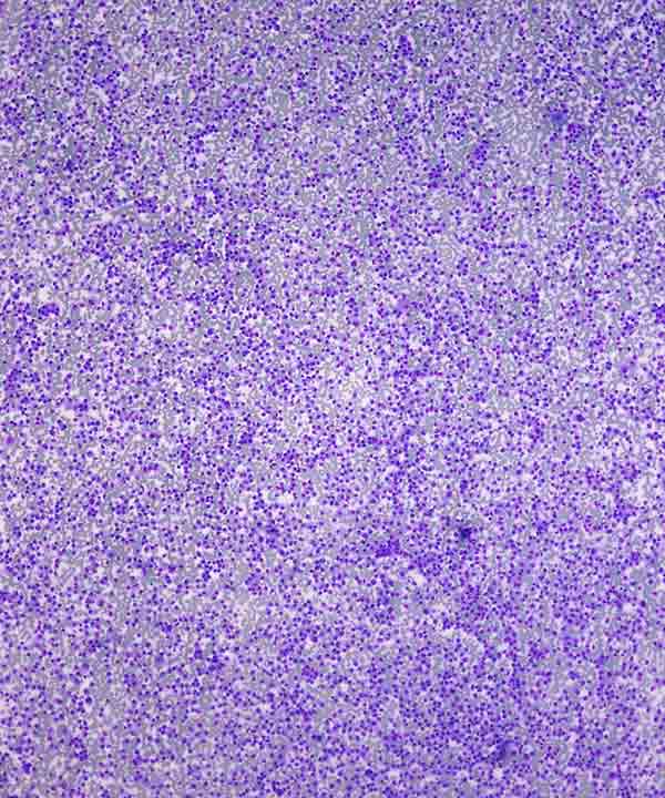 image showing 'Neuroendocrine Tumor Low Grade'