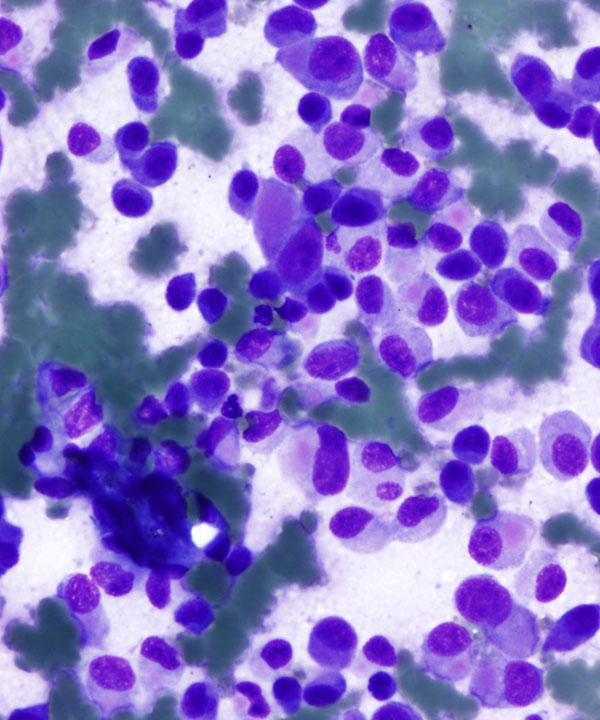8 : Pancreas Neuroendocrine Tumor Low Grade