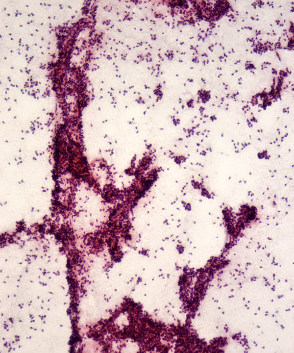 image showing 'Solid Pseudopapillary Neoplasm'