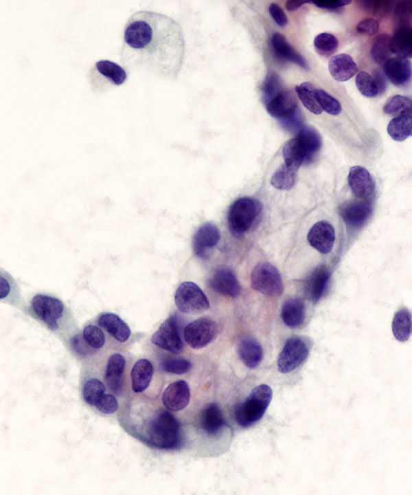 04 : Solid Pseudopapillary Neoplasm