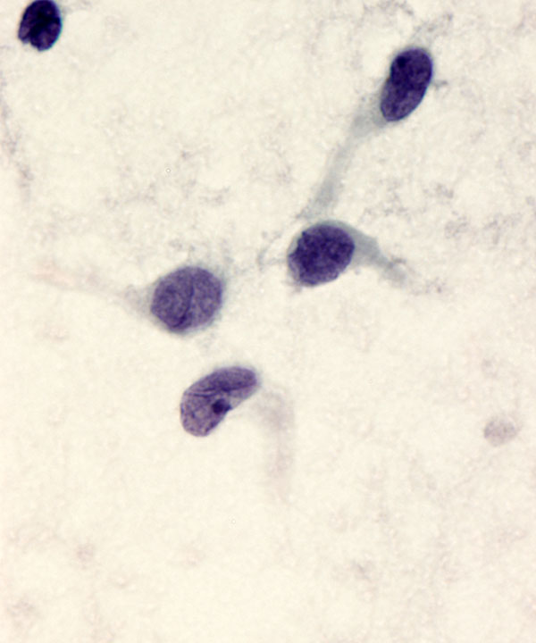 08 : Solid Pseudopapillary Neoplasm