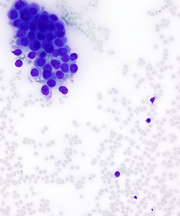 02 : Kidney Renal Medullary Carcinoma