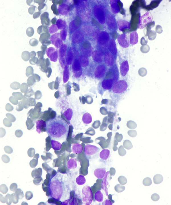 image showing 'Acinic Cell Carcinoma'