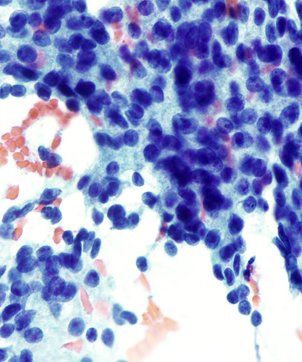 03 : Salivary Gland Acinic Cell Carcinoma