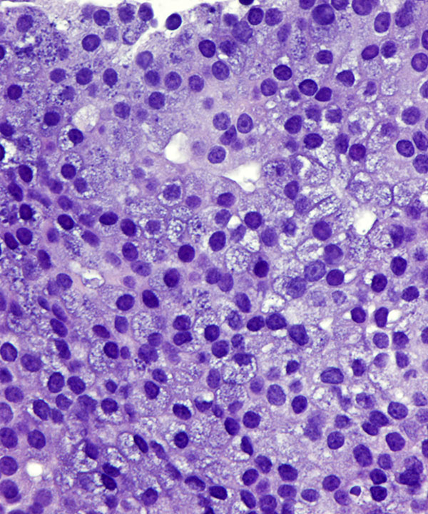 06 : Salivary Gland Acinic Cell Carcinoma