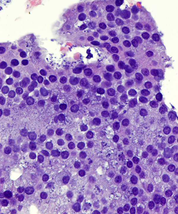 07 : Salivary Gland Acinic Cell Carcinoma