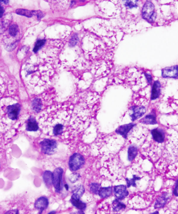 12 : Salivary Gland Acinic Cell Carcinoma