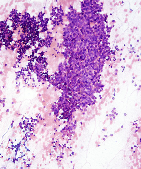 10 : Salivary Gland Adenoid Cystic Carcinoma