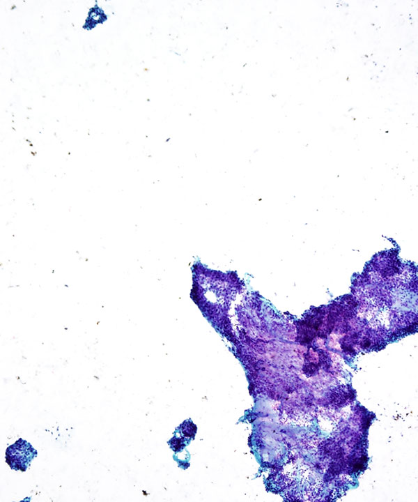 image showing 'Mucoepidermoid Carcinoma'