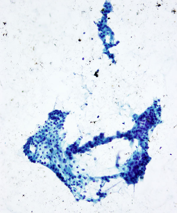 02 : Salivary Gland Mucoepidermoid Carcinoma