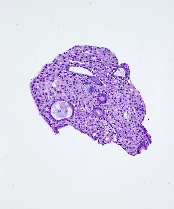 06 : Salivary Gland Mucoepidermoid Carcinoma