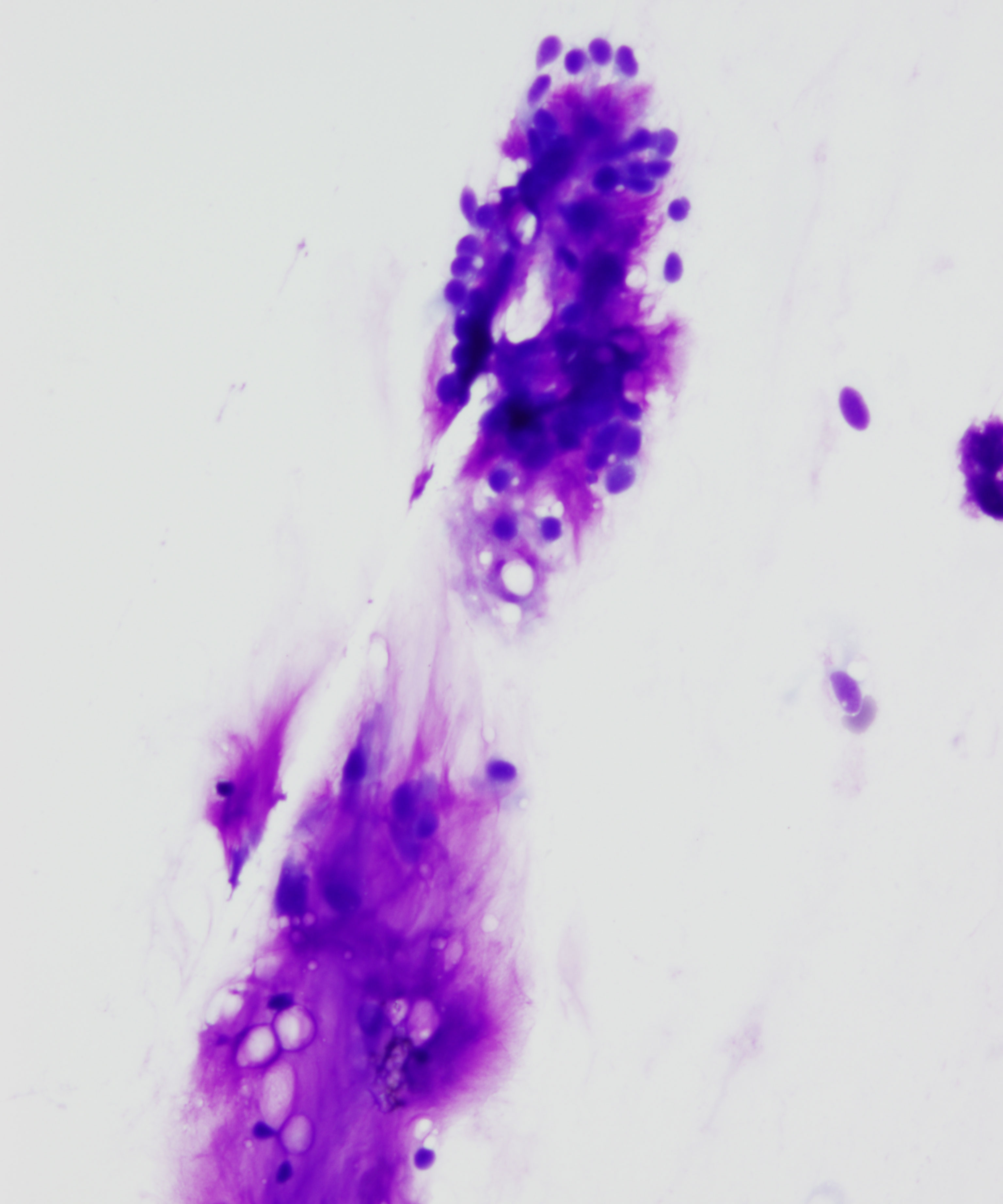 02 :  Salivary Gland Pleomorphic Adenoma