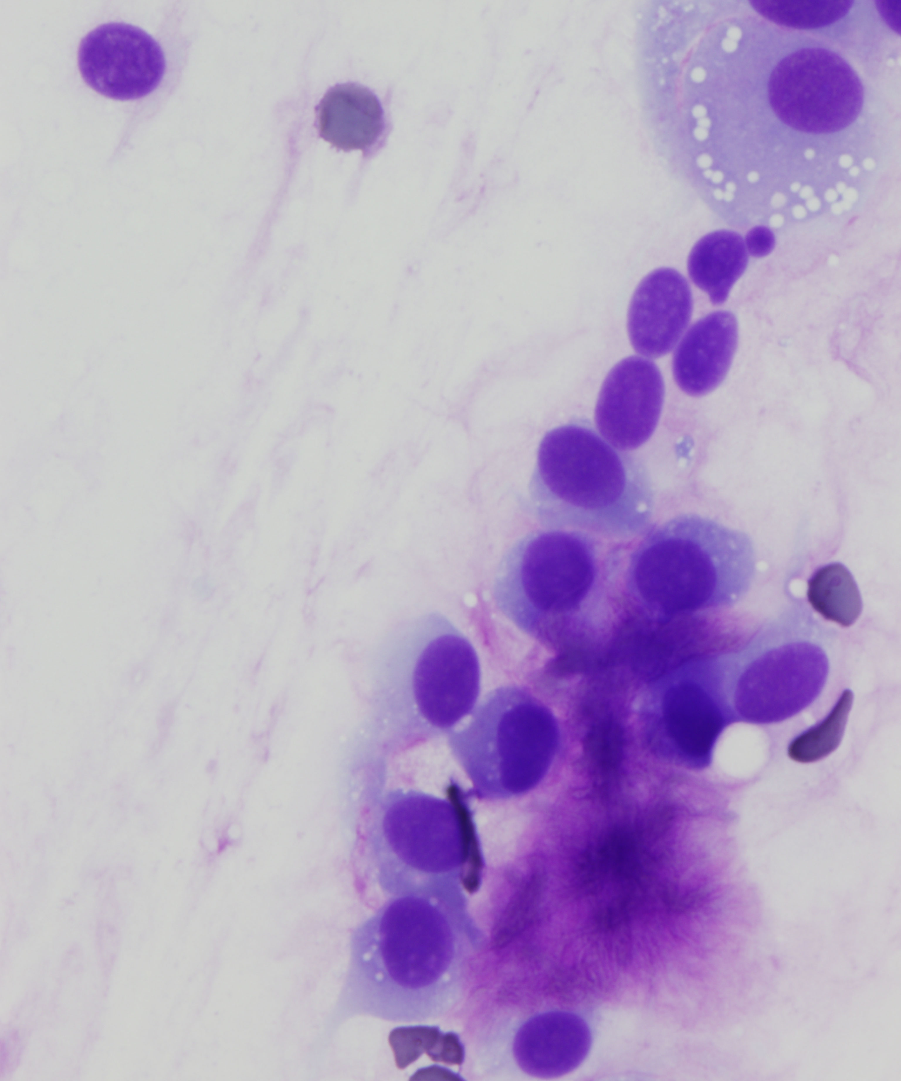 03 :  Salivary Gland Pleomorphic Adenoma
