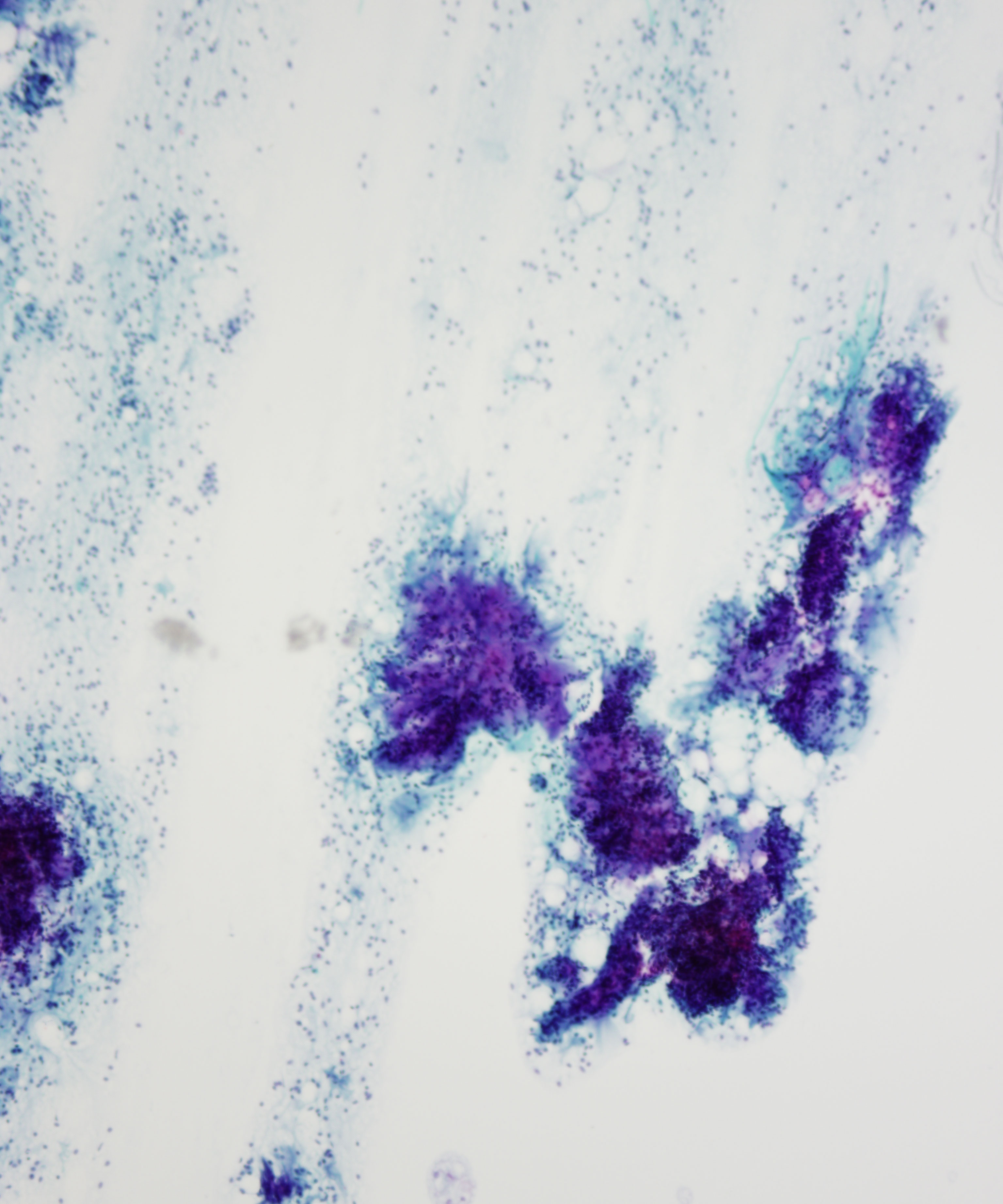 04 :  Salivary Gland Pleomorphic Adenoma