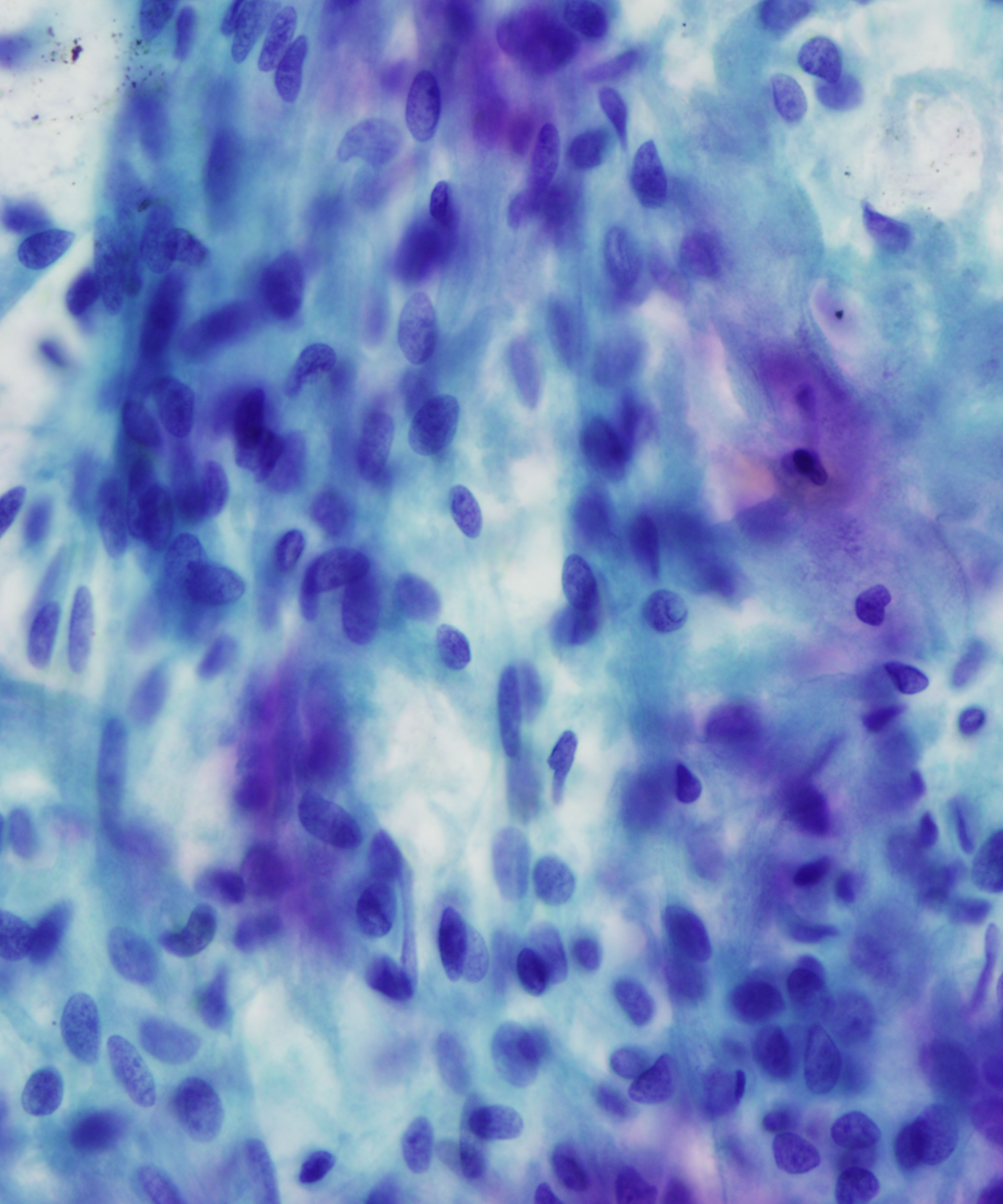 12 :  Salivary Gland Pleomorphic Adenoma