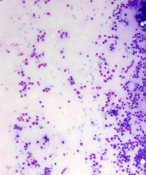 image showing 'Alveolar Rhabdomyosarcoma'
