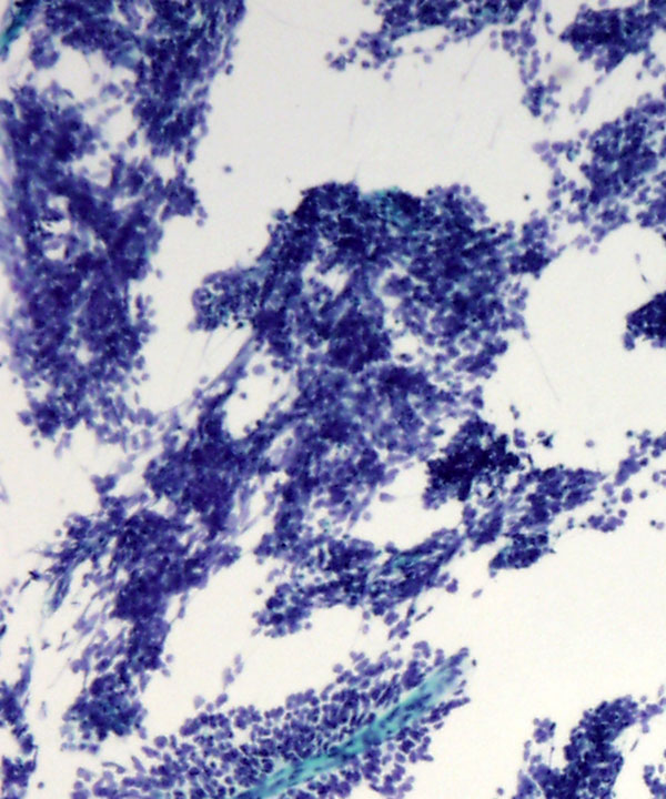 04 : Soft Tissue Alveolar Rhabdomyosarcoma