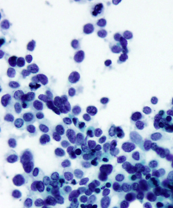 05 : Soft Tissue Alveolar Rhabdomyosarcoma