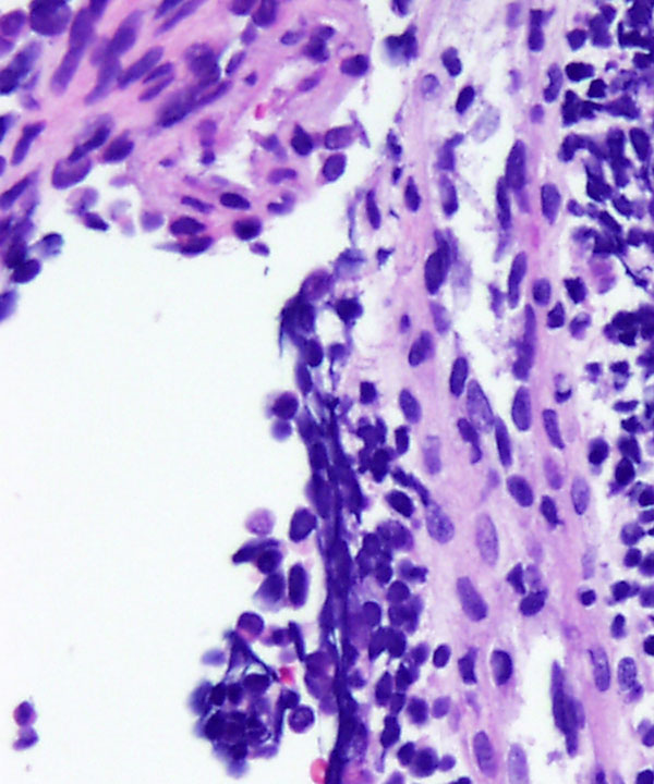 06 : Soft Tissue Alveolar Rhabdomyosarcoma
