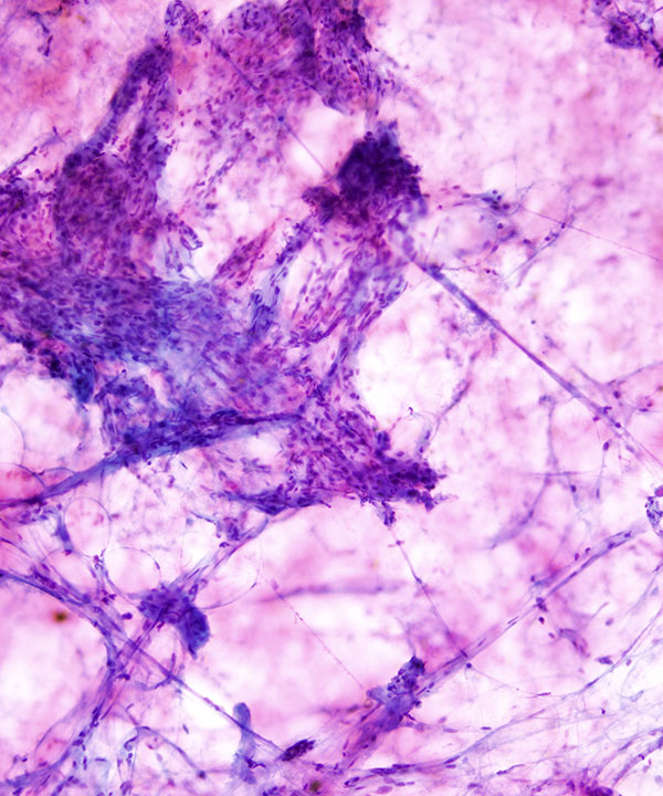 03 : Soft Tissue Angiolipoma