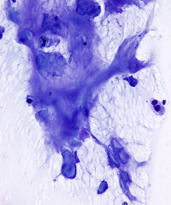 5 : Soft Tissue Chondroma