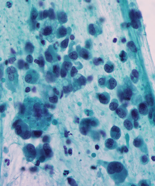 image showing 'Epithelioid Angiosarcoma'