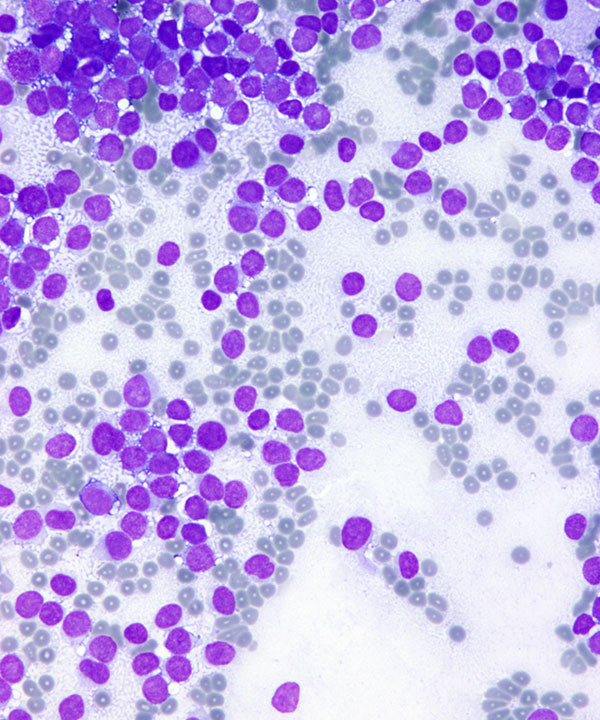 02 : Soft Tissue Ewing Sarcoma