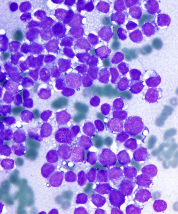 04 : Soft Tissue Ewing Sarcoma