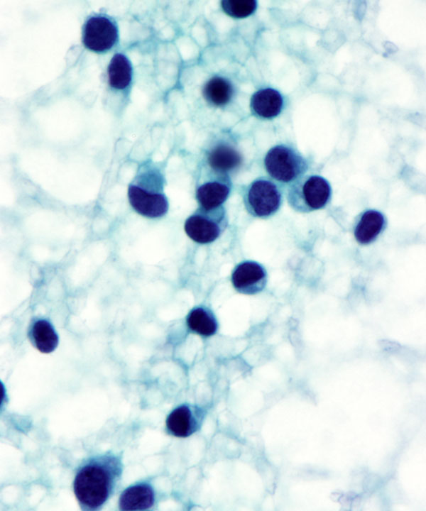 07 : Soft Tissue Ewing Sarcoma