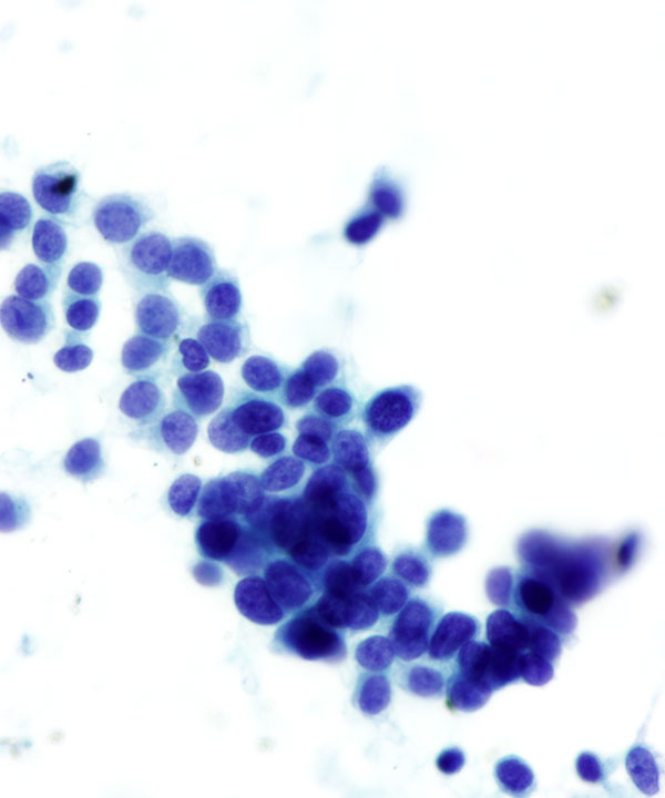 09 : Soft Tissue Ewing Sarcoma