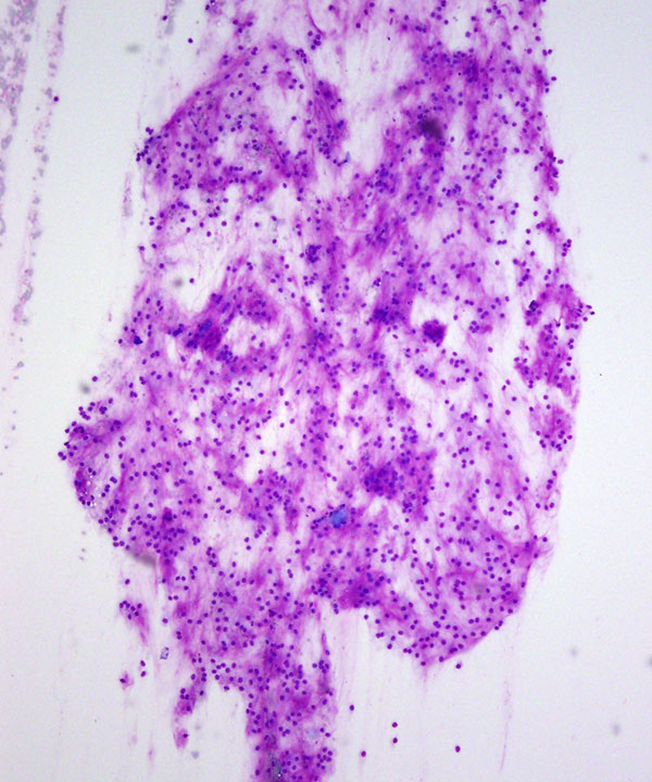 image showing 'Extraskeletal Myxoid Chondrosarcoma'