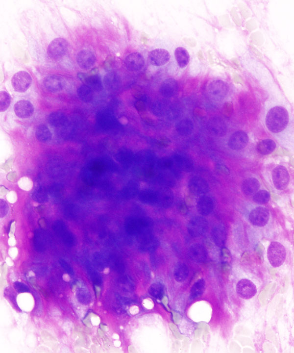 02 : Soft Tissue Extraskeletal Myxoid Chondrosarcoma