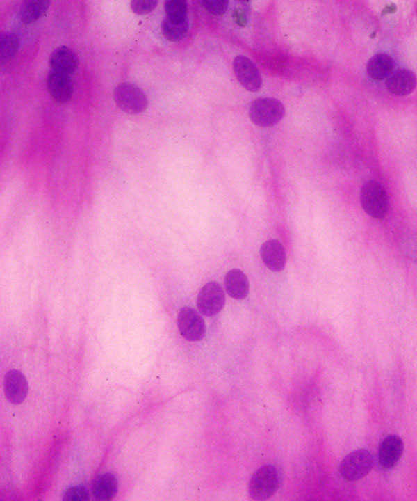 04 : Soft Tissue Extraskeletal Myxoid Chondrosarcoma