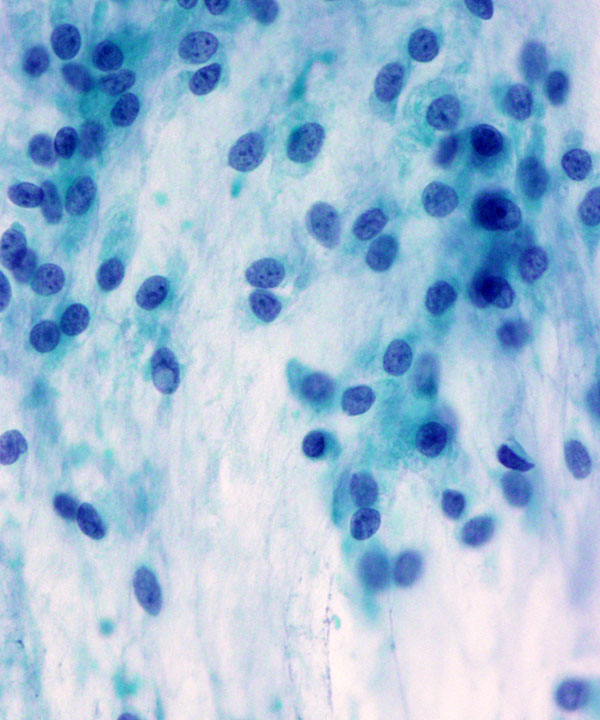 06 : Soft Tissue Extraskeletal Myxoid Chondrosarcoma