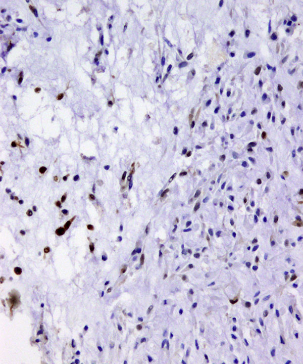 09 : Soft Tissue Extraskeletal Myxoid Chondrosarcoma