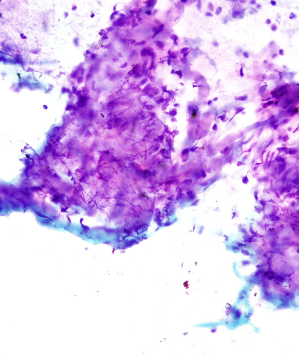 image showing 'Leiomyosarcoma (LMS)'