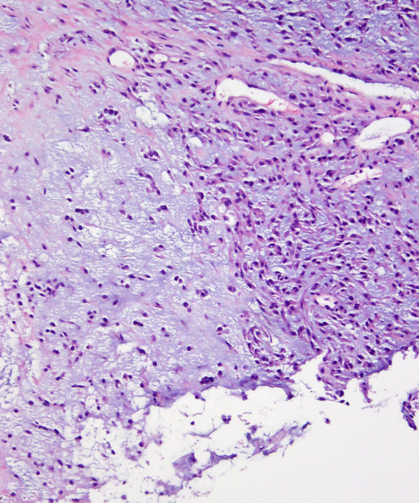 image showing 'Myxoid Chondrosarcoma'