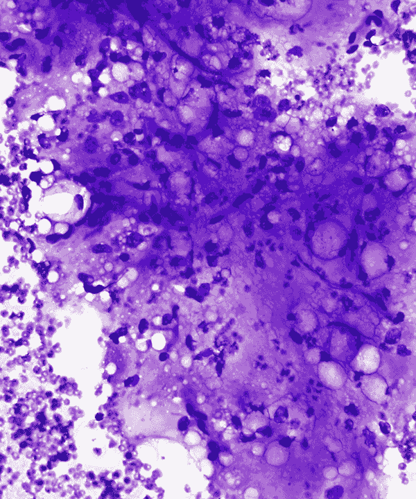 1 : Soft Tissue Myxoid Liposarcoma