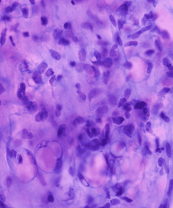 2 : Soft Tissue Myxoid Liposarcoma