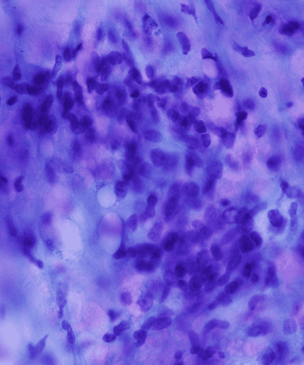 3 : Soft Tissue Myxoid Liposarcoma