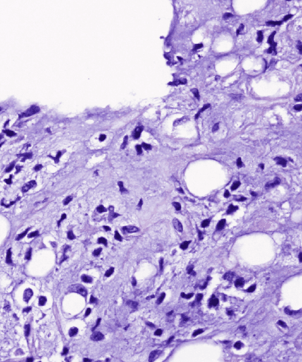 4 : Soft Tissue Myxoid Liposarcoma