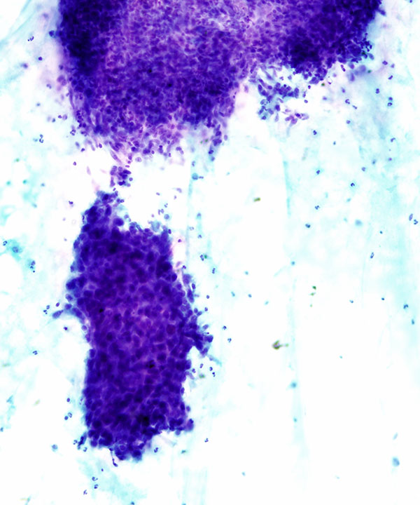 image showing 'Anaplastic (Undifferentiated) Carcinoma'
