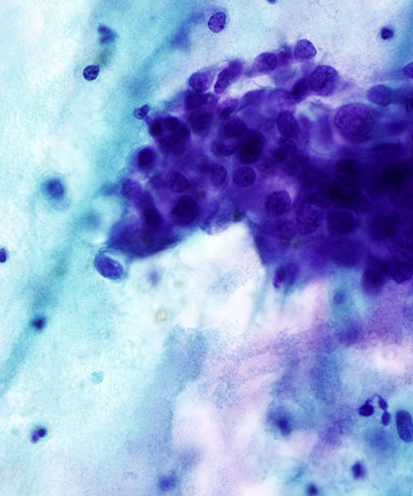 03 : Thyroid Anaplastic (Undifferentiated) Carcinoma