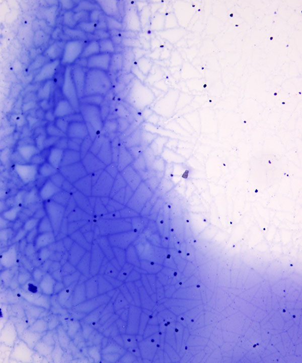 02 : Thyroid Colloid Nodule