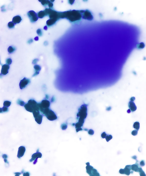 04 : Thyroid Colloid Nodule