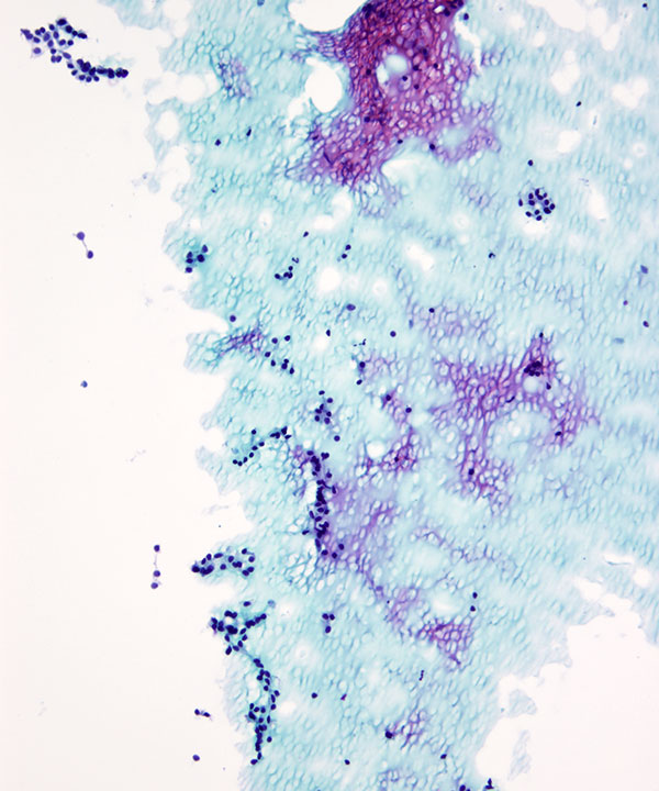 07 : Thyroid Colloid Nodule