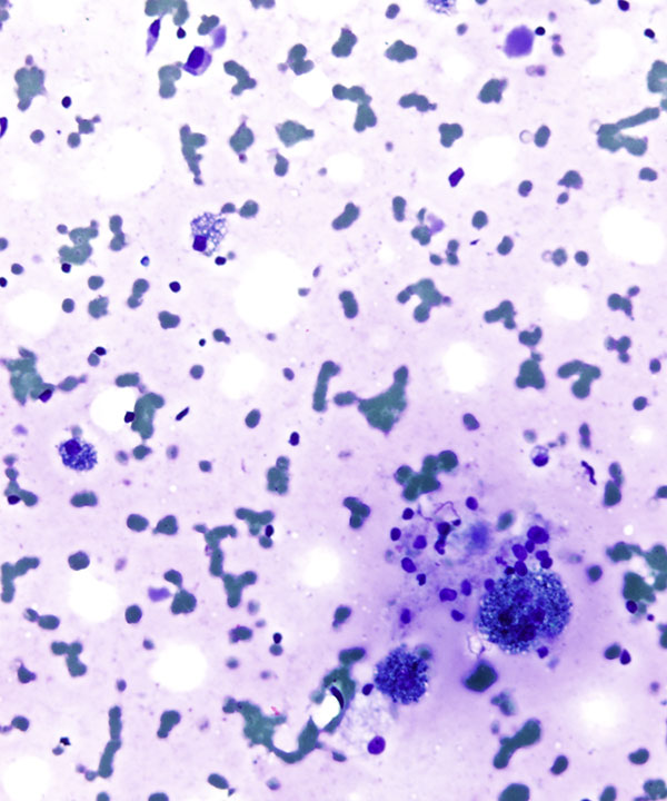 10 : Thyroid Colloid Nodule